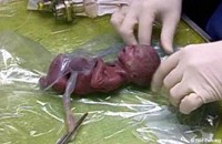 Nyaris Seukuran Pena, Bayi Terkecil Di Dunia Itu dibolehkan Pulang