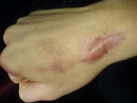 Penyakit Keloid Bisa Berbahaya Jika Tidak Diobati